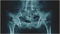 Orthopädiezentrum Wien - Fibroostosen bei einer Person, Schmerzen und Knochendeformationen.