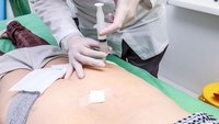Orthopädiezentrum Wien - Arzt führt eine Infiltration des Piriformismuskel unter bildwandler- und ultraschallgestützter Kontrolle aus.