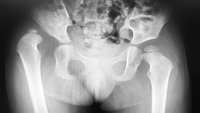 Orthopädiezentrum Wien - Röntgenaufnahme zeigt Hüftdysplasie bei einem Kind.