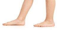 Orthopädiezentrum Wien - Sichelfuss bei einer Person in der seitlichen Ansicht