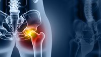 Orthopädiezentrum Wien - Hüftschnupfen bei einer Person, Darstellung einer entzündeten Hüfte auf Röntgenaufnahme